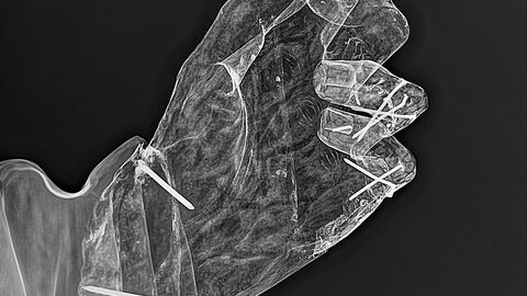 Röntgenaufnahme der rechten Hand des Hl. Antonius aus Höchst. Röntgenaufnahme der rechten Hand des Hl. Antonius aus Höchst.